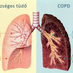 copd201711 1