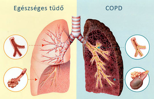 copd201711 1